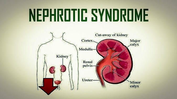 cause of nephrotic syndrome