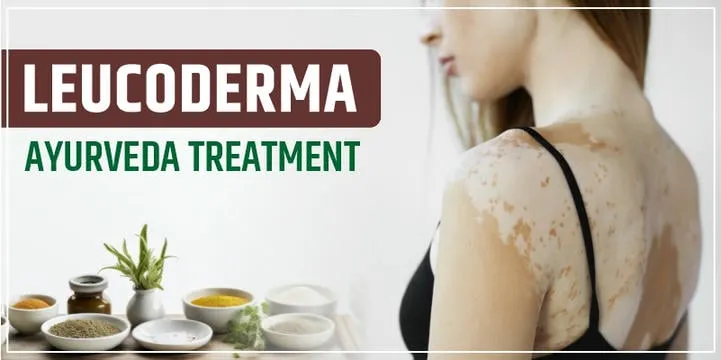 leucoderma-ayurveda-treatment