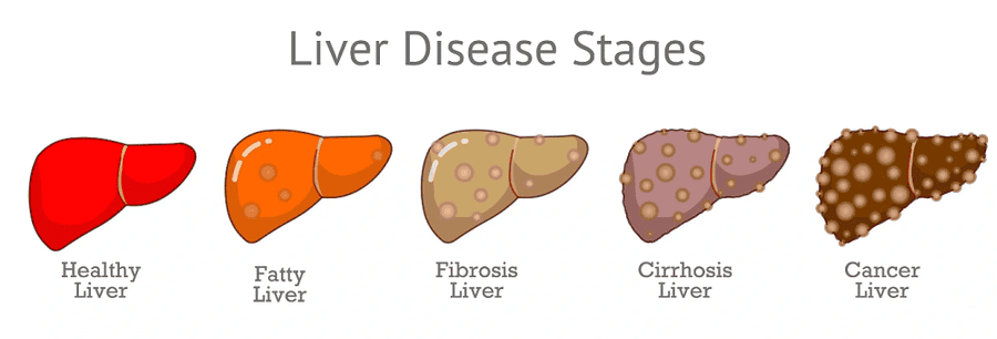 medicine-for-fatty-liver-in-ayurveda