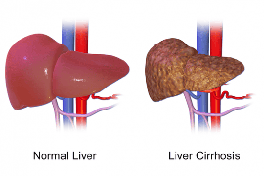 Ayurvedic Medicine for Cirrhosis