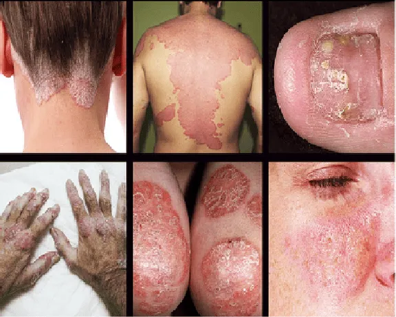 Psoriasis Ayurveda Treatment
