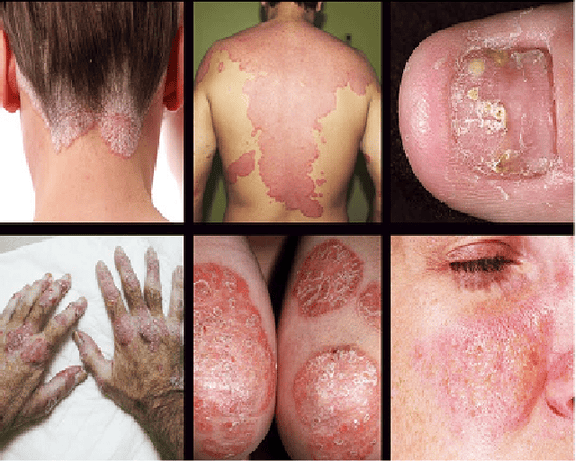 psoriasis-ayurveda-treatment