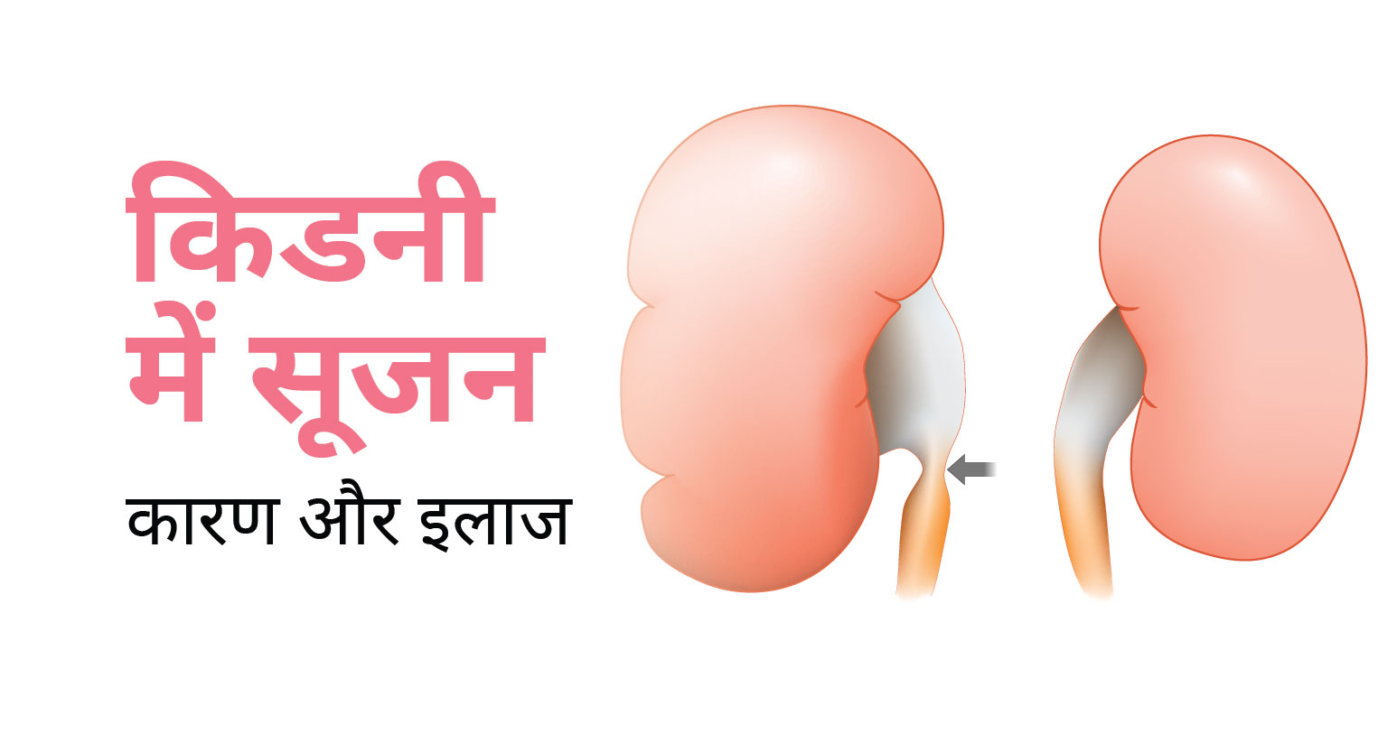 किडनी-में-सूजन-के-लक्षण-और-उपाय