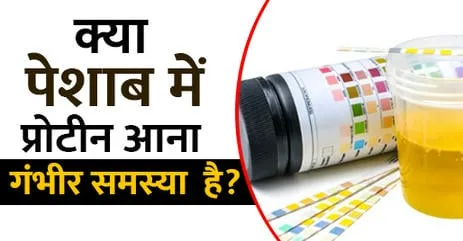 यूरिन-में-प्रोटीन-आना-आयुर्वेदिक-इलाज