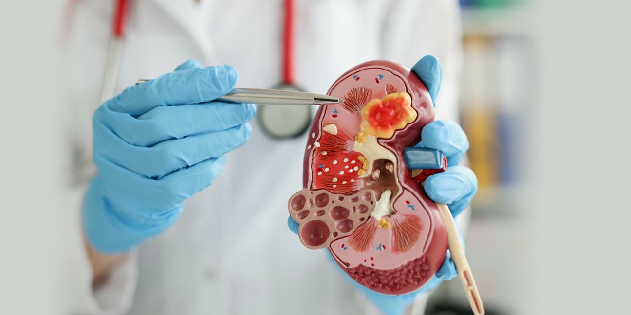 ayurveda-kidney-cure
