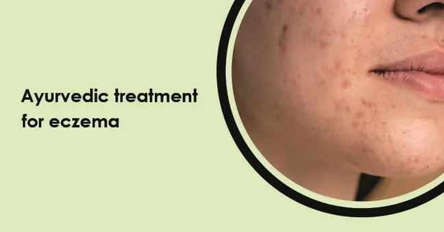 best-ayurvedic-medicine-for-eczema