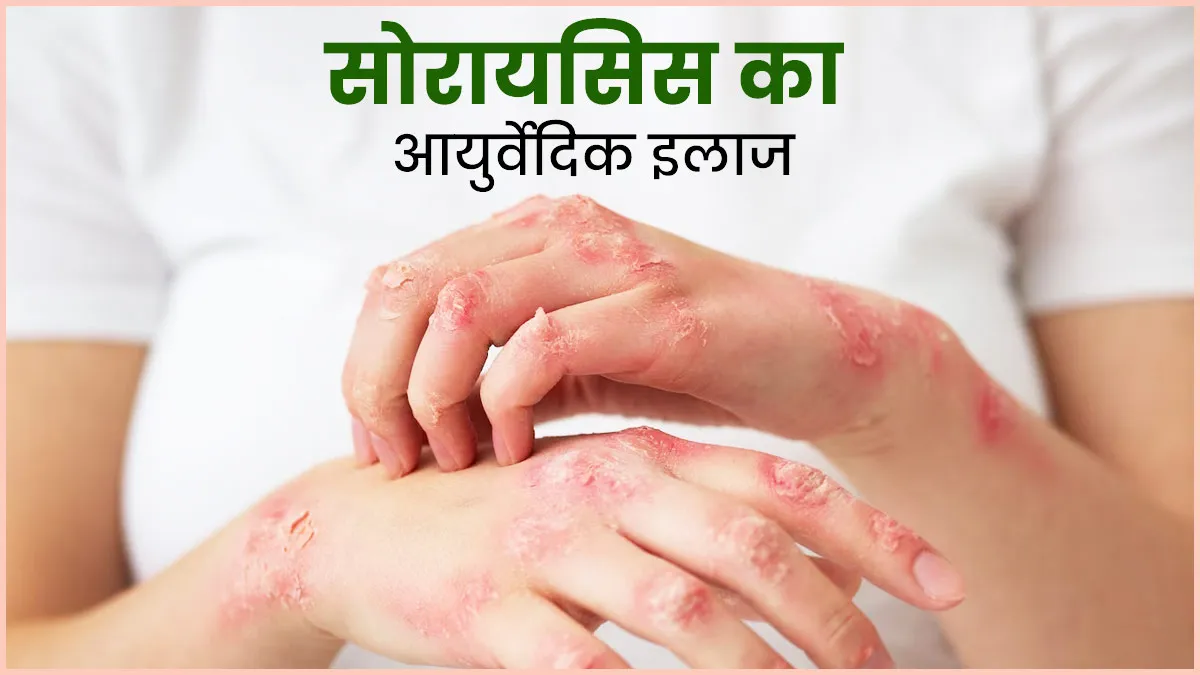 आयुर्वेद में सोरायसिस रोग का इलाज