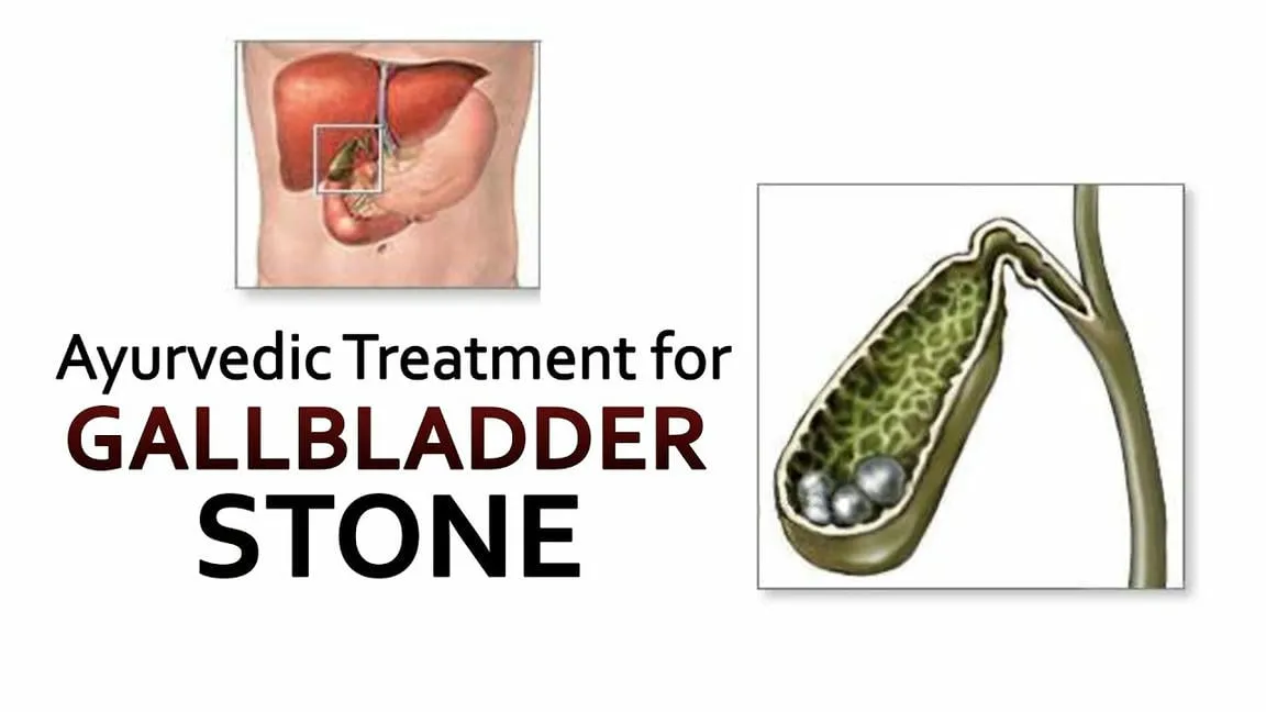 Gallbladder Stone Ayurvedic Treatment