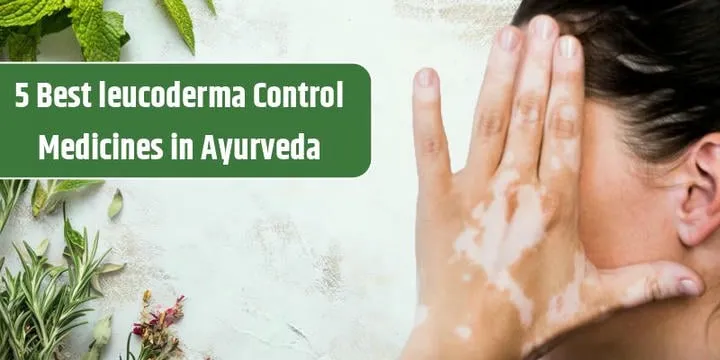 5 Best Leucoderma Control Medicines in Ayurveda