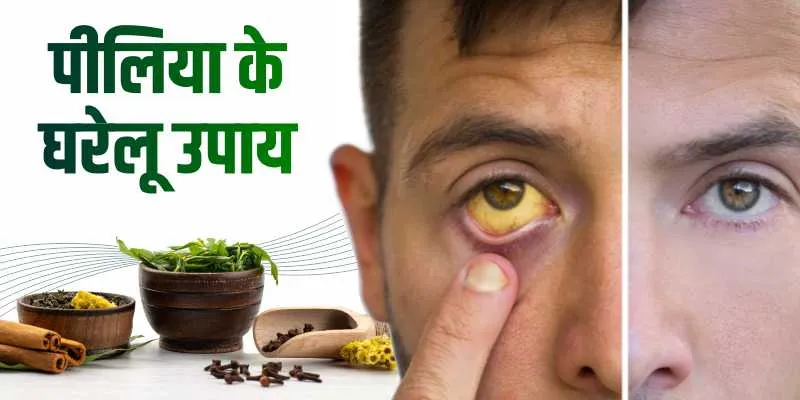 पीलिया के घरेलू उपाय - कर्मा आयुर्वेदा