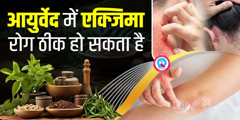 आयुर्वेदा-में-एक्जिमा-रोग-ठीक-हो-सकता-है