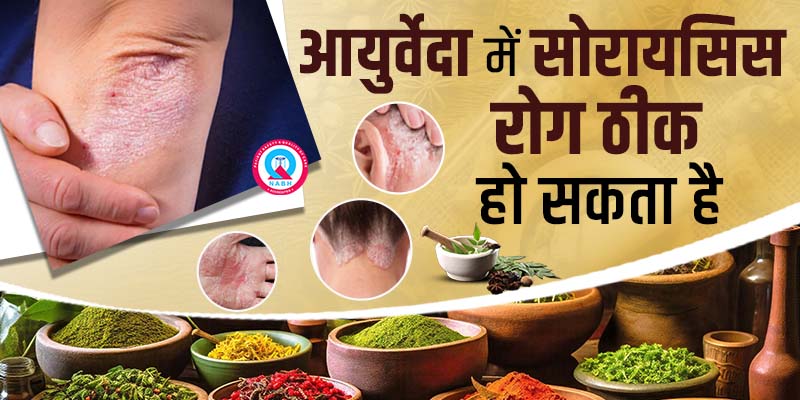 आयुर्वेदा-में-सोरायसिस-रोग-ठीक-हो-सकता-है