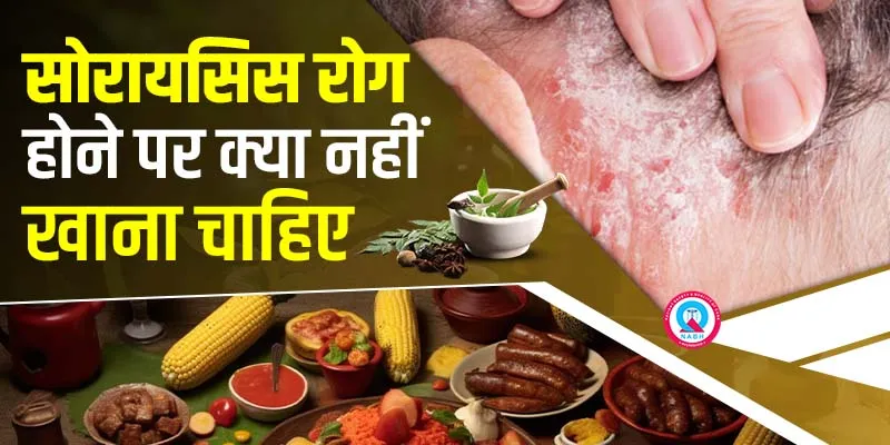 सोरायसिस-रोग-होने-पर-क्या-नहीं-खाना-चाहिए