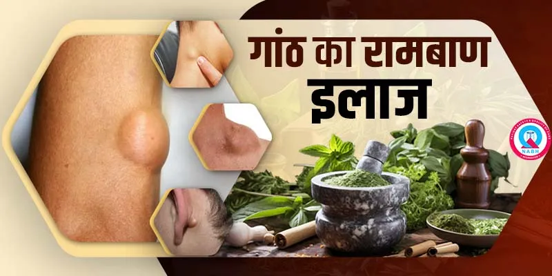 गांठ-का-रामबाण-इलाज