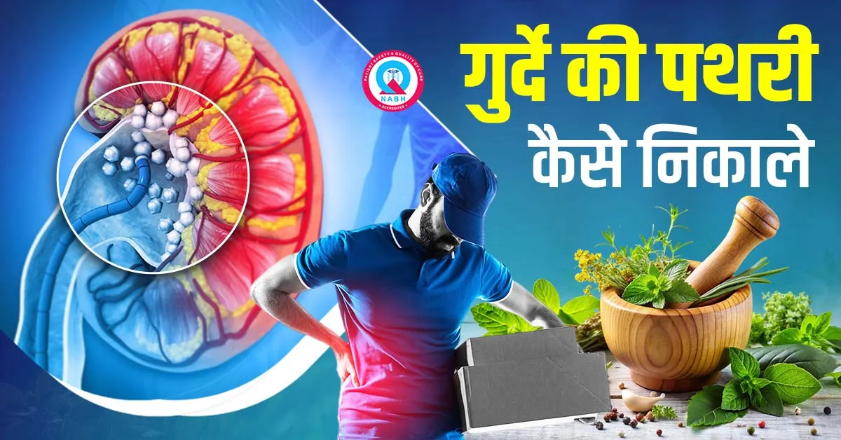गुर्दे-की-पथरी-कैसे-निकाले