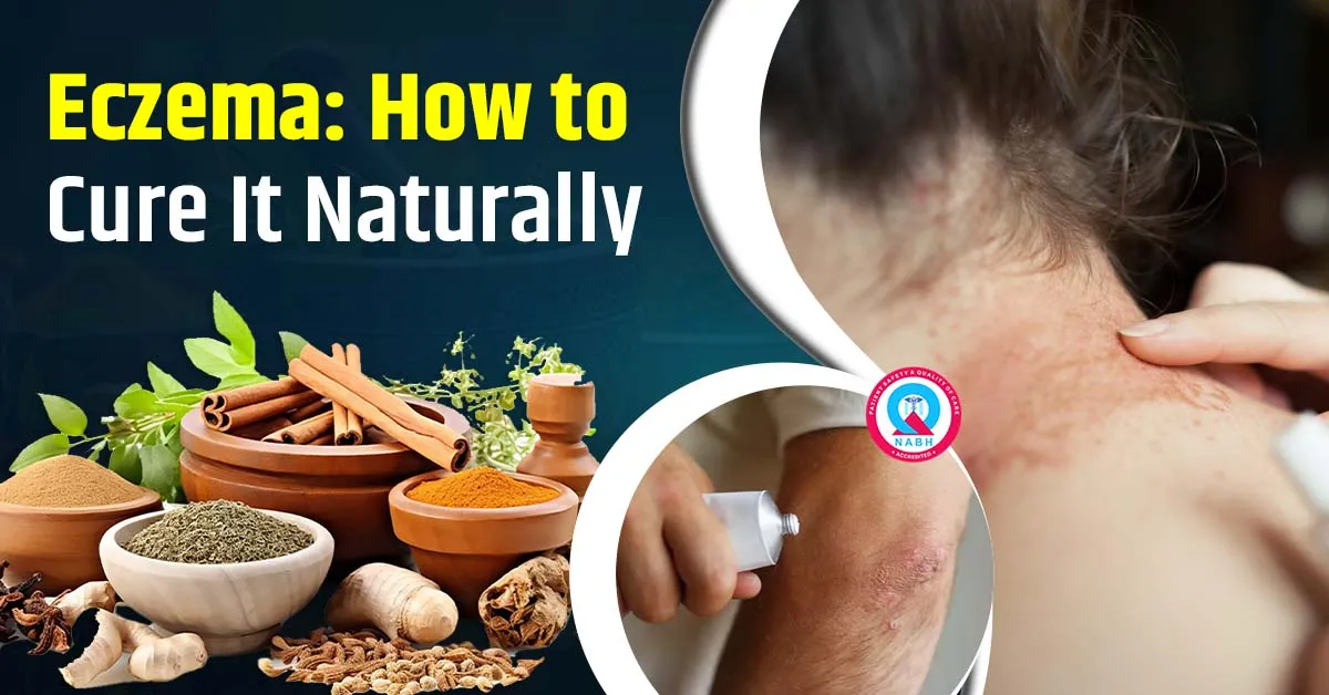 eczema-how-to-cure-it-naturally