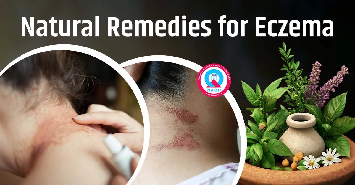 Natural Remedies for Eczema: Because Your Skin Deserves a Break