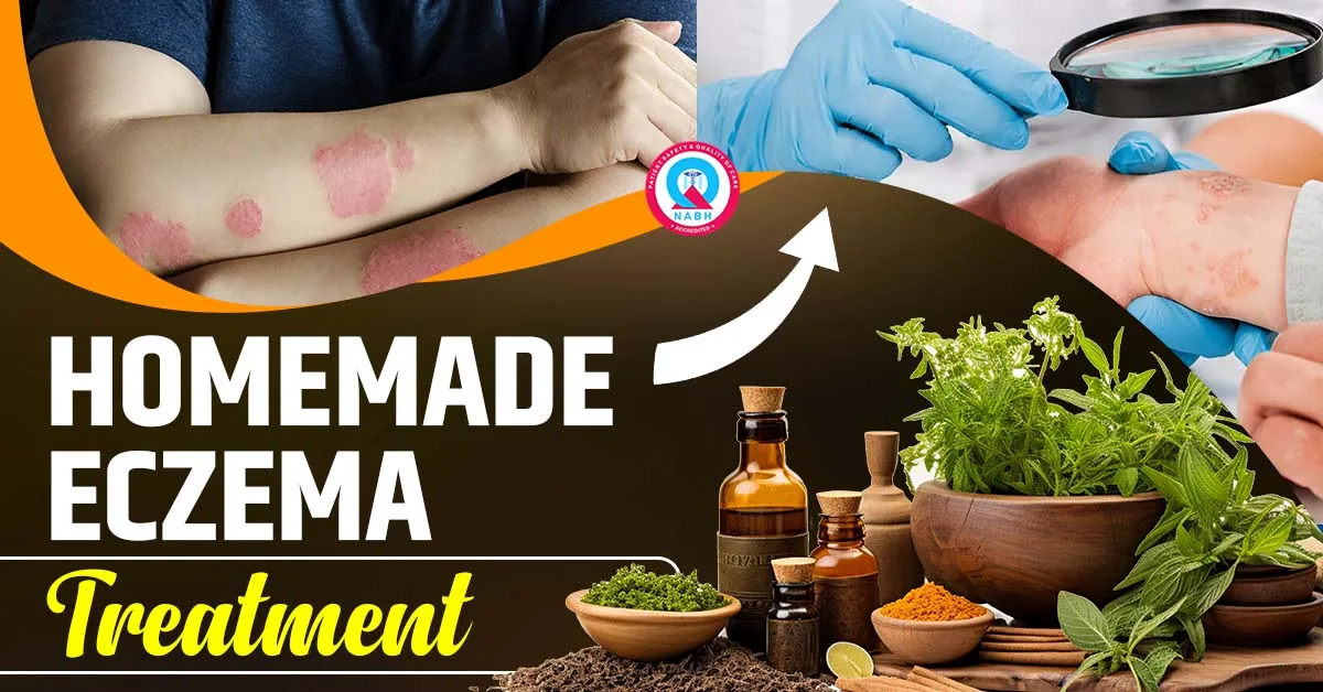 homemade-eczema-treatment