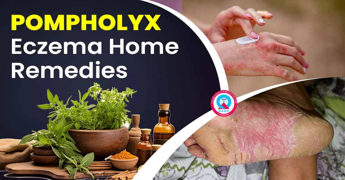 pompholyx-eczema-home-remedies