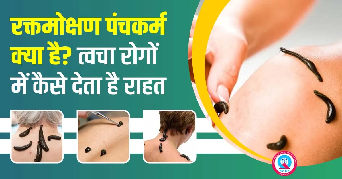 रक्तमोक्षण-पंचकर्म-क्या-है