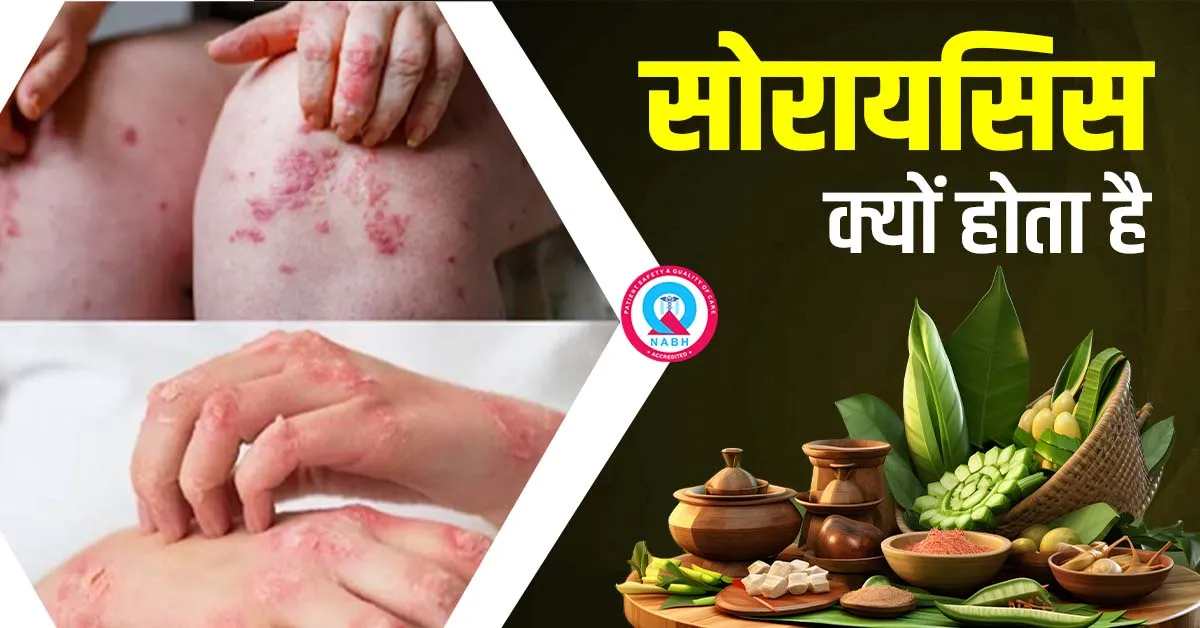 सोरायसिस क्यों होता है