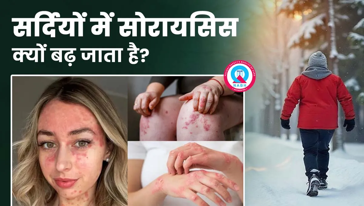 सर्दियों-में-सोरायसिस-क्यों-बढ़-जाता-है