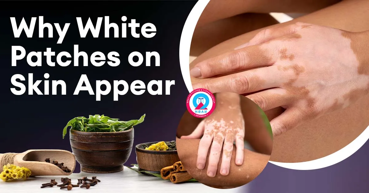 Why White Patches on Skin Appear | Causes of White Patches