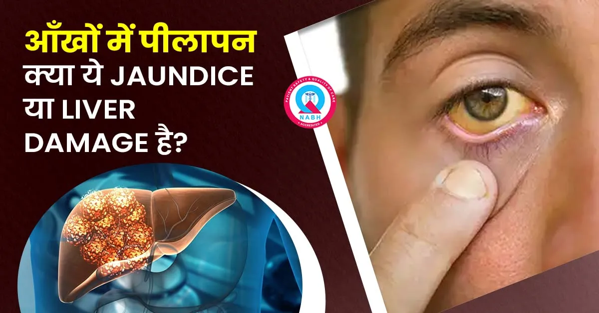 आँखों में पीलापन क्या ये Jaundice या Liver Damage है?