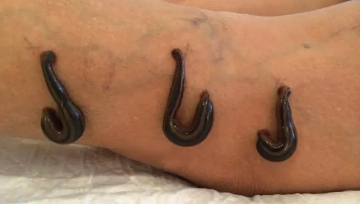 Leech Therapy